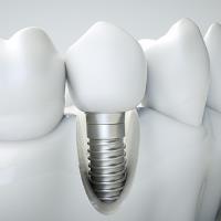Greenfield Laser & Dental Implant Center image 3